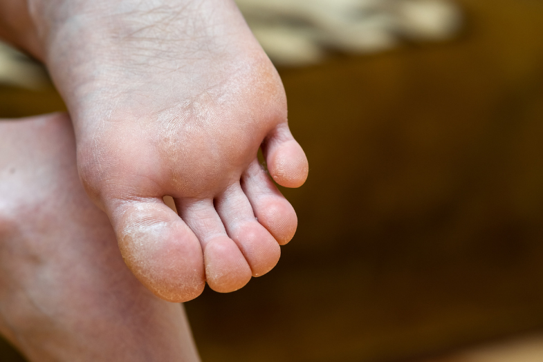 How To Get Rid Of Calluses on Feet, Elbows & Knees — Derm to Door