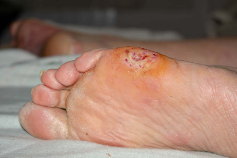 Diabetic foot | Issues | PiedReseau