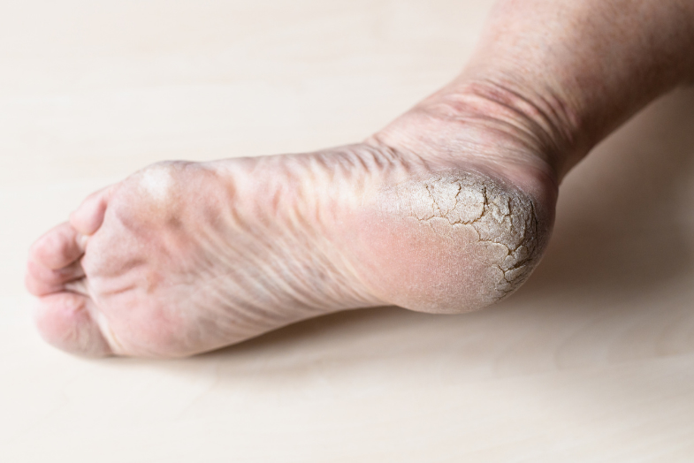 https://www.footandanklespec.com/wp-content/uploads/2022/07/rough-cracked-skin-on-heel-of-male-foot-2022-01-30-02-13-07-utc.jpg